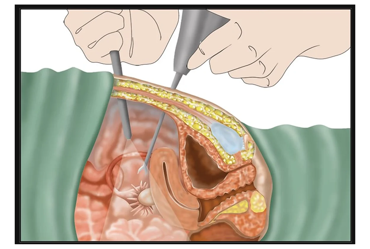 Laparoscopic Hysterectomy (Uterus Removal)