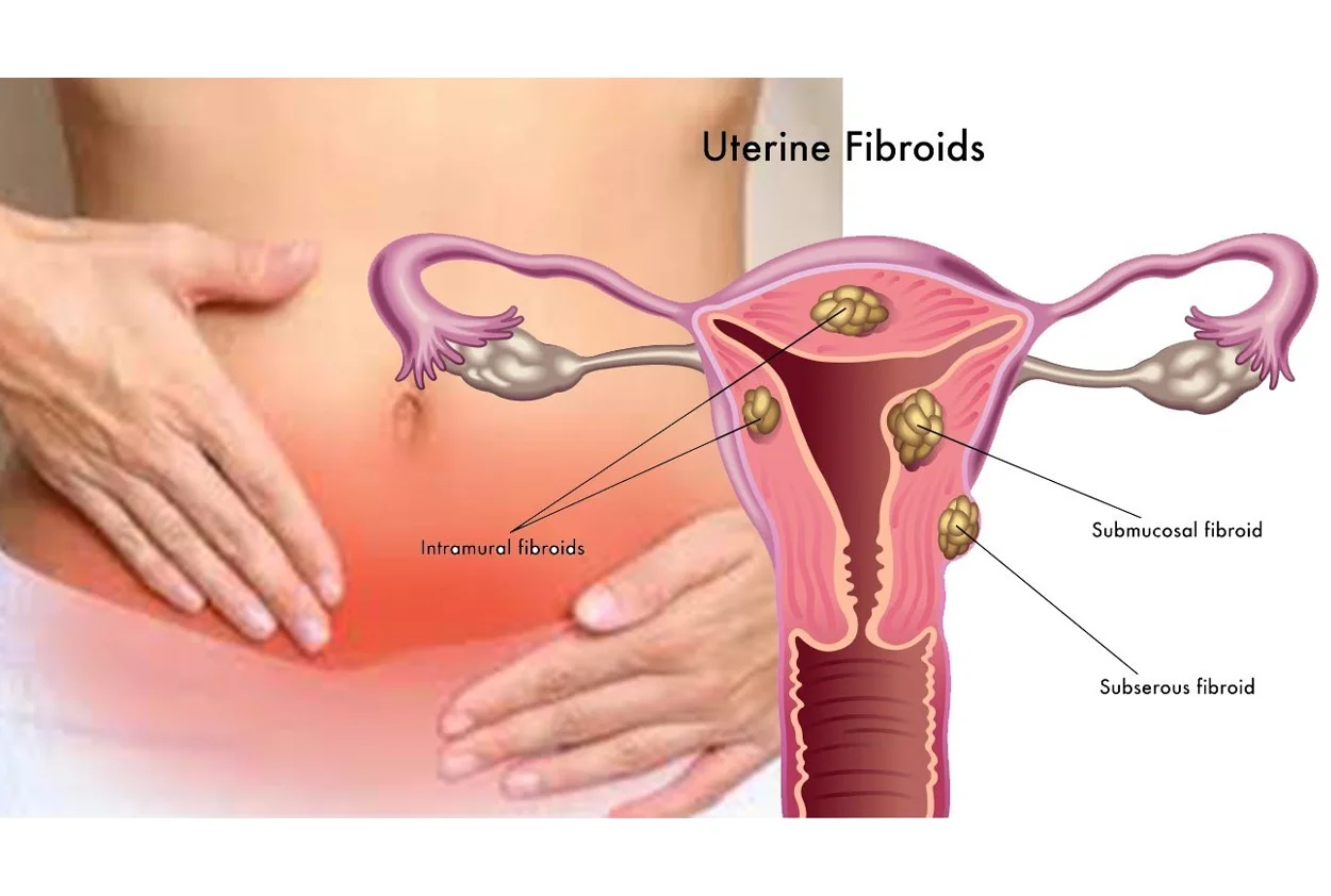 Laparoscopic Myomectomy (Uterine Fibroid Removal)