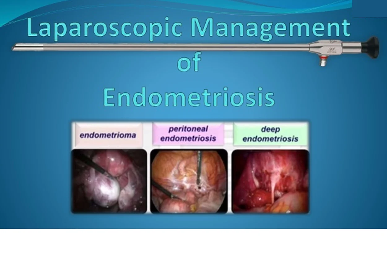 Laparoscopic Management of Endometriosis