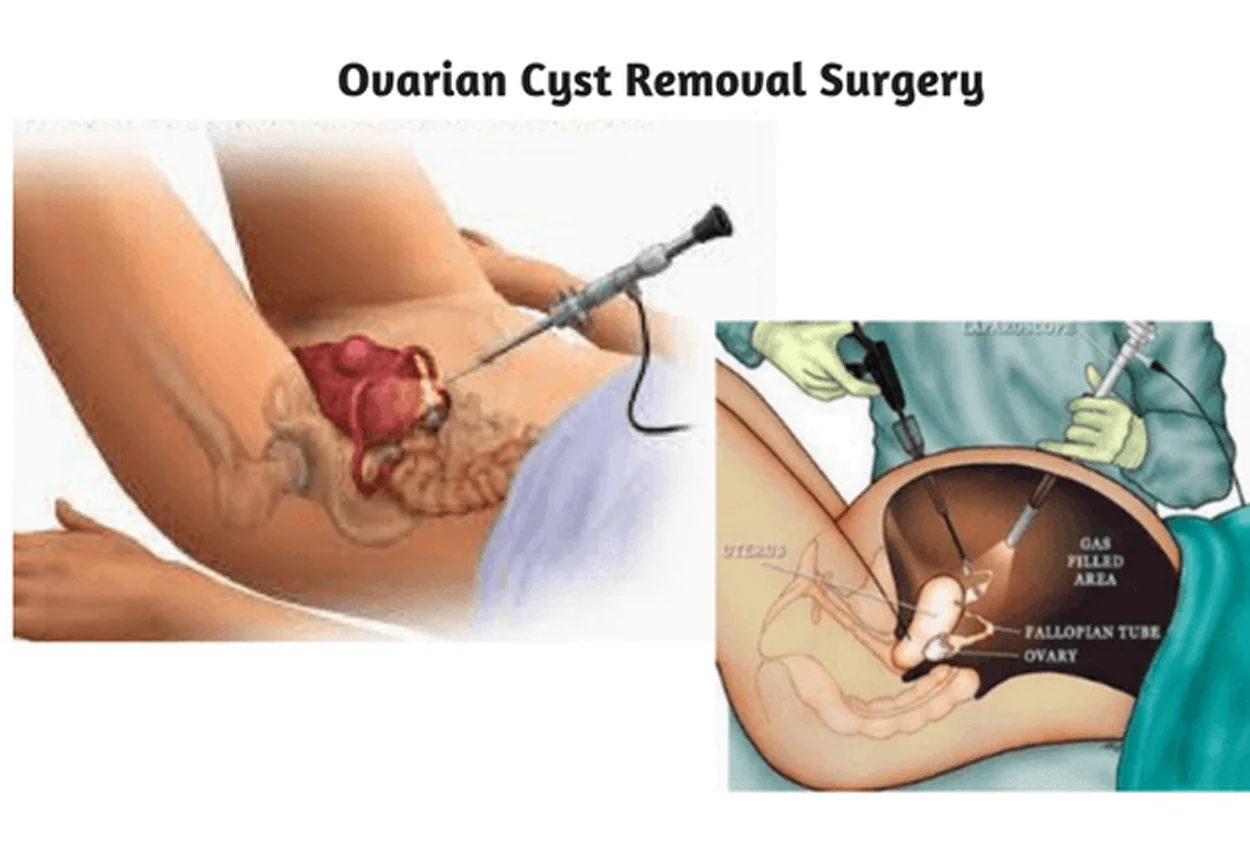 Laparoscopic Ovarian Cystectomies (Ovarian Cyst Removal)