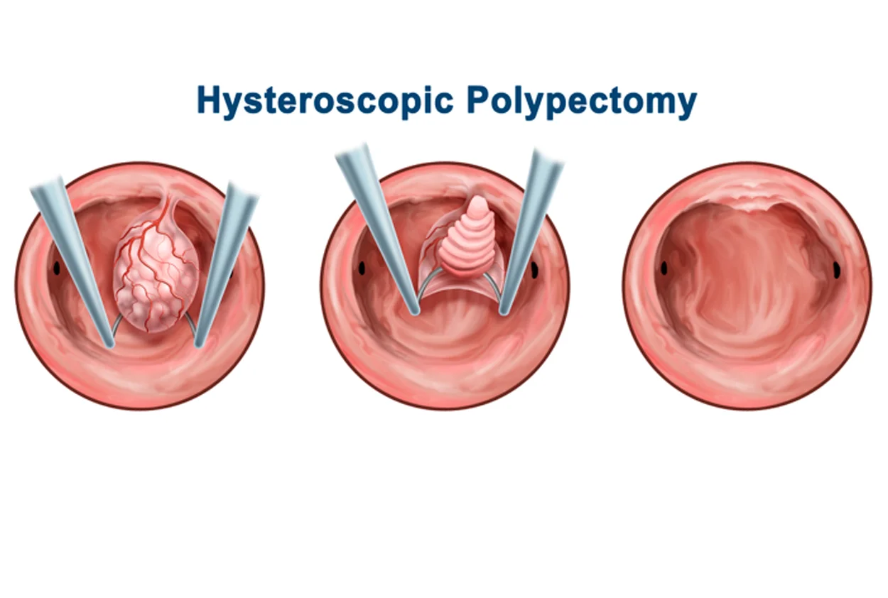 Laparoscopic Polypectomy (Polyp Removal)